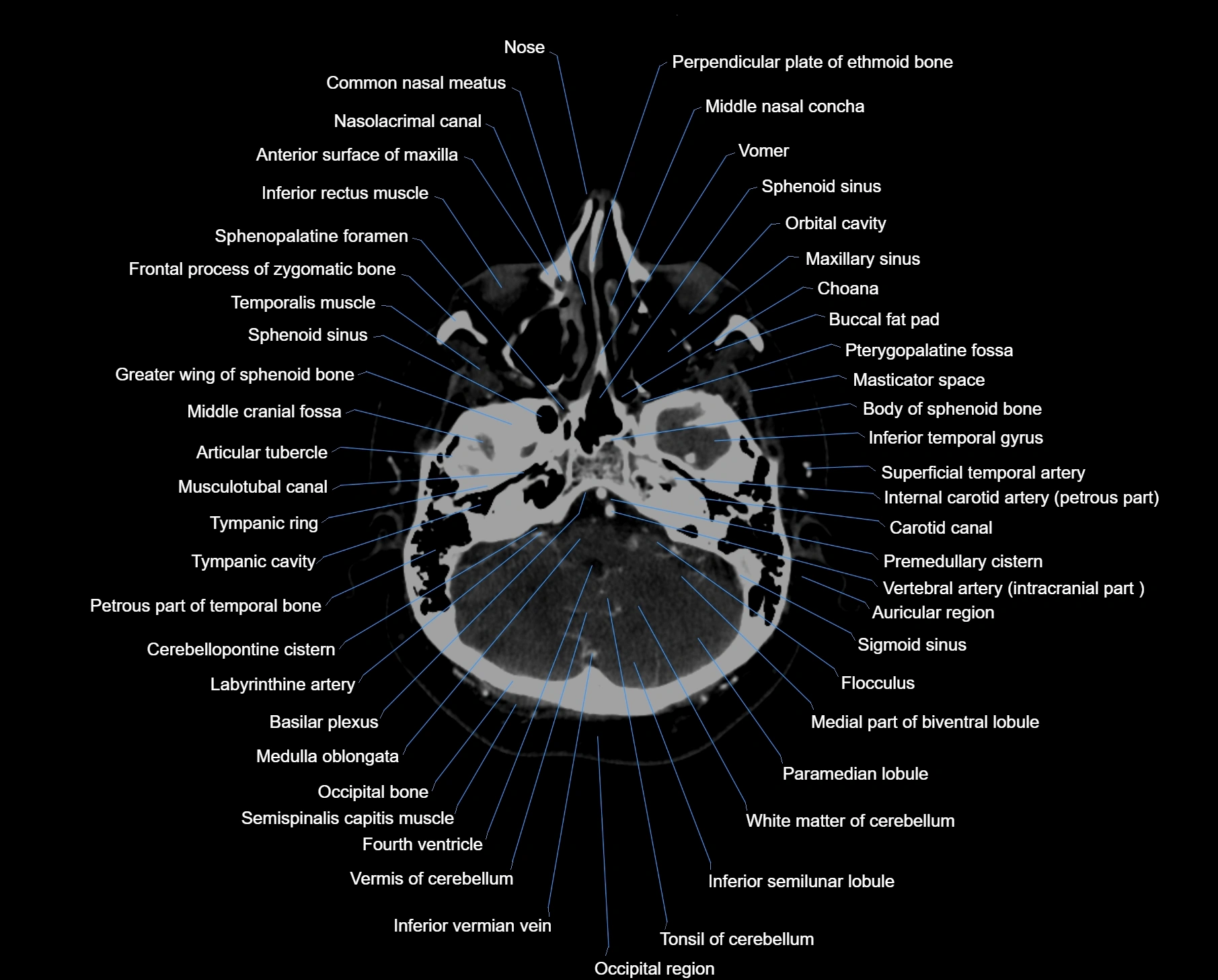 CT scan brain axial labelled cross sectional anatomy image-img-000014.webp